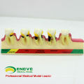 TOOTH09 (12585) Modelos de Doenças Periodontais Crônicas